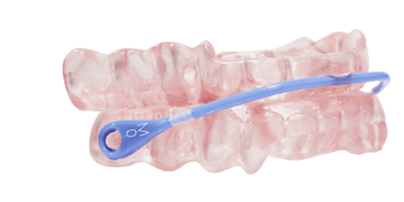 SomnoDent Avant oral appliance example